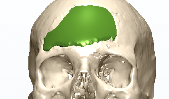 •Cerhum is creating revolutionary made-to-measure bone grafts